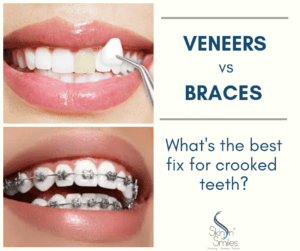 Veneers vs Braces – What’s the Best Fix for Crooked Teeth?