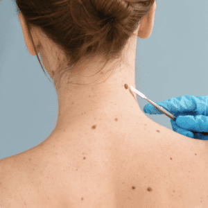 Surgical removal of moles