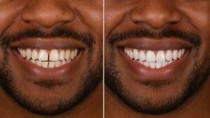 How veneers improve your smile