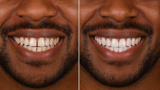 How veneers improve your smile
