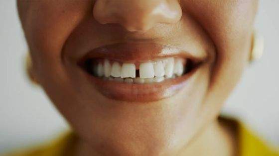 Why are gaps appearing between my teeth?