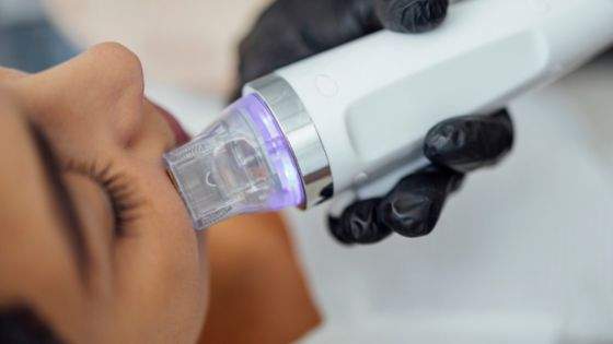 MNRF treatment for acne scars and skin rejuvenation
