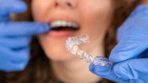 How Invisalign treatment is planned: From 3D scan to your new smile